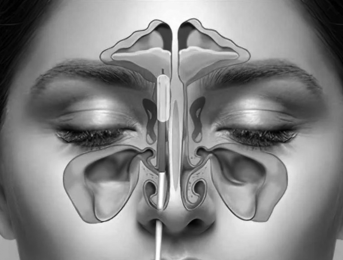 Sinus Endoscopy